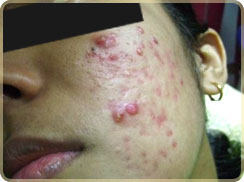 laser skin care clinic kerala