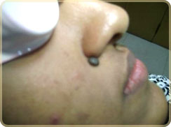 Laser Skin Care in Cochin