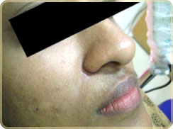 Skin Care Treatments in Kerala