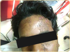 Laser Treatment in Cochin