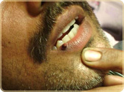 Laser Skin Treatments in Kerala